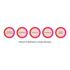 Diagram showing Vitamin A deficiency related ocular diseases - keratomalcia, xerophthalmia, night blindness, bitot's spots - simplified schematic diagram.