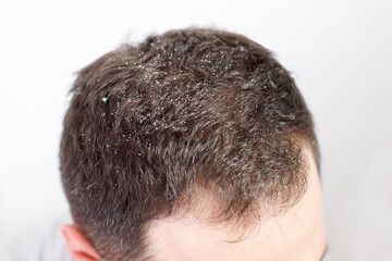 dandruff male head on white background