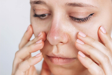 Sunburn, redness of the nose. Young woman worried about her red skin of the nose isolated on white background. Result of tanning. Dryness, skin irritation, allergies, inflammation, acne, blackheads