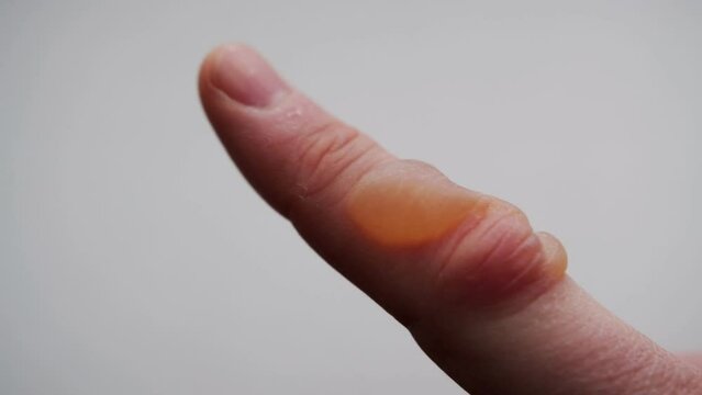 Thermal burn on a finger with a blister on a white background. Burn treatment concept, degree of burn, close-up. Copy space for text
