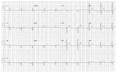 Rhythm of heart on graph using for fetal heart monitoring