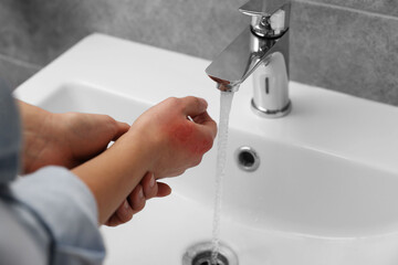 Woman holding burned hand under cold water indoors, closeup. Space for text
