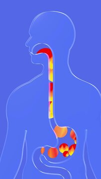 3d animation of esophagus and stomach with gastric reflux and burning. With circles of fire moving upward. Digestive system and human silhouette made of transparent glass on a blue background.