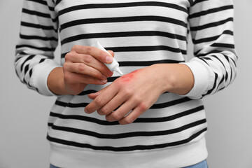 Woman applying healing cream onto burned hand on light grey background, closeup