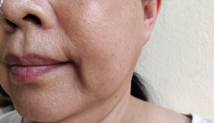 close up of a woman showing the flabbiness and wrinkle beside the mouth, dark spots and blemish on...