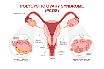 Polycystic Ovary Syndrome (PCOs) Cross sections illustration educational