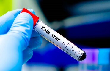 Fototapeta premium Blood sample of patient positive tested for kala azar.