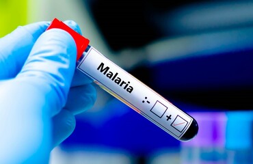 Fototapeta premium Blood sample of patient positive tested for malaria.