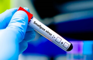 Fototapeta premium Blood sample of patient positive tested for smallpox virus.