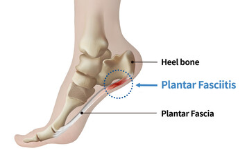 Foot anatomy medical illustration showing plantar fasciitis