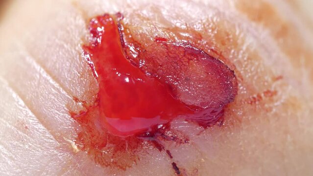 Injury to middle finger of right hand with bleeding. Flayed skin, red blood and lymphatic fluid flows from wound. UHD 4K macro shot video
