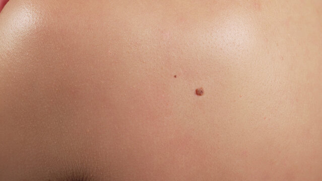 Human papillomavirus. Female back covered with nevuses. Birthmark of Papiloma