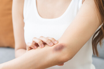 Close up of stain bruise wound on arm, contusion asian young woman, girl an accident fell down...