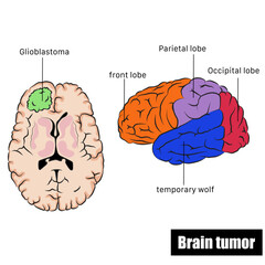 Vector brain tumor, also called brain cancer.