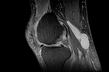 Nuclear Magnetic Resonance of right knee that shows baker cyst, fracture of external meniscus and...