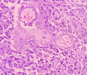 Astrocytoma, Intramedullary SOL (C5-D3) tissue biopsy. Photomicrograph show malignant neoplasm of...