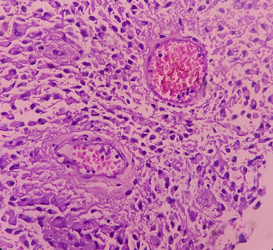 Mature cystic teratoma, Ovarian cyst biopsy, show cyst wall of skin and adnexal structure, fatty tissue, salivary acini and cartilage. Cystic teratoma of dermoid cyst.