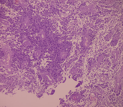 Astrocytoma, Intramedullary SOL (C5-D3) tissue biopsy. Photomicrograph show malignant neoplasm of oval to elongated cells with eccentric cuclei and eosinophilic cytology. Micovascular proliferation.
