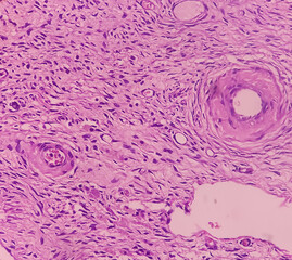Uterus with adnexa (biopsy): Cervix show chronic inflamatory cells, wall show secretory phase in...