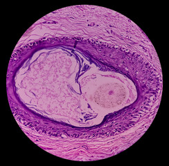Mature cystic teratoma, Ovarian cyst biopsy, show cyst wall of skin and adnexal structure, fatty...