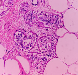 Mature cystic teratoma, Ovarian cyst biopsy, show cyst wall of skin and adnexal structure, fatty...