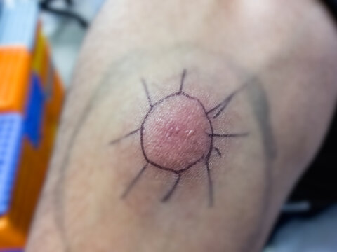 Mantoux tuberculin skin test (TST), Closeup view photography of patient arm with red spot reaction to conducting Mantoux test. Positive tuberculosis patient. PPD skin test.