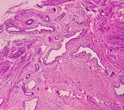 Uterus with adnexa (biopsy): Cervix show chronic inflamatory cells, wall show secretory phase in endometrium and fallopian tube show paratubal cyst. fimbrial cyst, Paraovarian cyst.