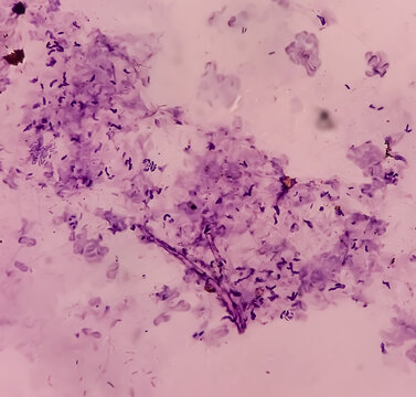 Uterus with adnexa (biopsy): Cervix show chronic inflamatory cells, wall show secretory phase in endometrium and fallopian tube show paratubal cyst. fimbrial cyst, Paraovarian cyst.