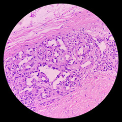 Swelling of middle finger (biopsy). Lobular Capillary hemangioma. A benign neoplasm of increased number of vessels with RBC lined by endothelial cells. Benign vascular proliferations.