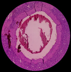 Swelling of middle finger (biopsy). Lobular Capillary hemangioma. A benign neoplasm of increased...