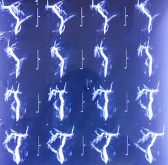 MRCP film of MRI of abdomen. Tiny granular calculi, hepaticolithiasis. Liver, bile duct, pancreas duct for medical health diagnosis.