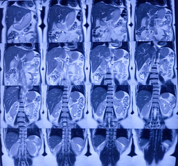 MRCP film of MRI of abdomen. Tiny granular calculi, hepaticolithiasis. Liver, bile duct, pancreas duct for medical health diagnosis.