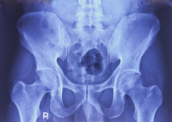 SI joint x-ray. Mild sclerosis at articular margin. Early sacroiliitis. Erosion. - obrazy, fototapety, plakaty