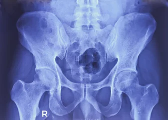 Fotobehang SI joint x-ray. Mild sclerosis at articular margin. Early sacroiliitis. Erosion. © MdBabul