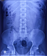 X-ray of KUB region. Bowel gas and fecal matter. Normal finding.