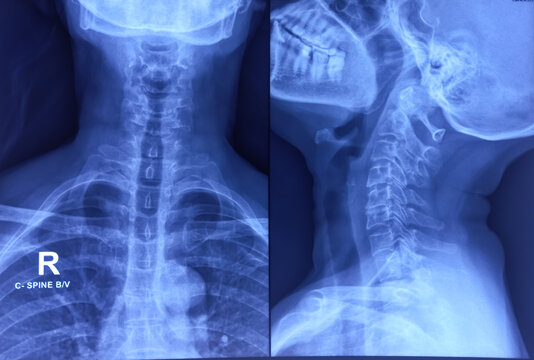 Cervical spine x-ray showing spondylosis of cervical spine. Marginal osteophytes. Cervical spondylosis.