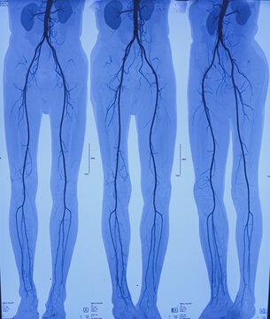 CT angiogram (CTA) shown the abdominal aorta, kidney and common iliac artery. Calcified plaques in lower part of aorta. Atherosclerotic change. CT angiography for determine vascular disease trauma.