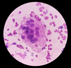 FNA cytology of swelling of chest wall. Infected epidermal inclusion cyst. Commonly called 