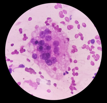 FNA cytology of swelling of chest wall. Infected epidermal inclusion cyst. Commonly called "sebaceous cyst". Smears show anucleated squames admixed with plenty of polymorphs, lymphocytes, histiocytes.