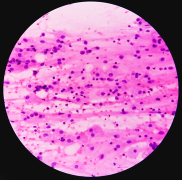 FNA cytology of swelling of chest wall. Infected epidermal inclusion cyst. Commonly called "sebaceous cyst". Smears show anucleated squames admixed with plenty of polymorphs, lymphocytes, histiocytes.