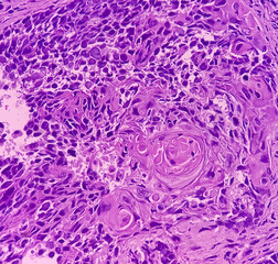 Larynx Cancer. Invasive squamous cell carcinoma. Section show malignant neoplasm.