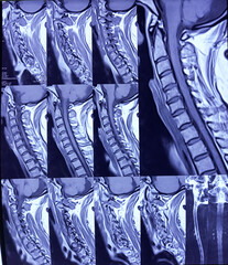 MRI of Cervical Spine and screening. Cervical spondyloarthropathy, thecal sac indentation at C4-C5 and C5-C6 level, indentation with nerve roots compression at C5-C6 level.