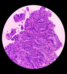 Tissue from antrum of stomach (endoscopic biopsy): Chronic nonspecific gastritis. Show gastric mucosa, chronic inflammatory cells infiltration in the lamina propria.