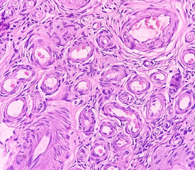 Photo of benign brenner tumor of ovary, showing tumor sheet on the right side and ovarian stroma on...