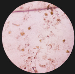 Giardia lamblia cysts and Trophozoite form, muscle fiber in stool examination, under 40X light...