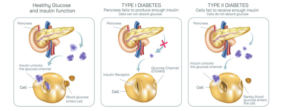 Difference between type one diabetes and type two diabetes. Where body cell do not absorb glucose to balance the insulin level vector illustration. Diabetes mellitus. Diabetes symptoms and prevention.