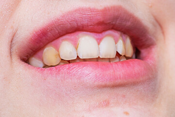 smile of restored teeth in a teenager with a corrected bite. Dental care and care