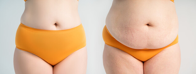 Woman's belly before and after liposuction and weight loss on gray background, plastic surgery concept - 745106296