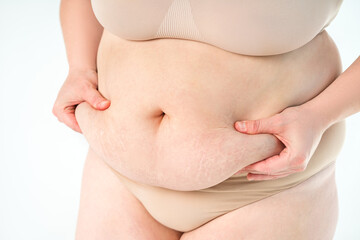 Tummy tuck, flabby skin with stretch marks on a fat belly, plastic surgery concept on gray background - 745106415