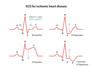 ECG for coronary heart disease. Types of coronary heart disease. Cardiogram of the heart. Vector illustration in flat style